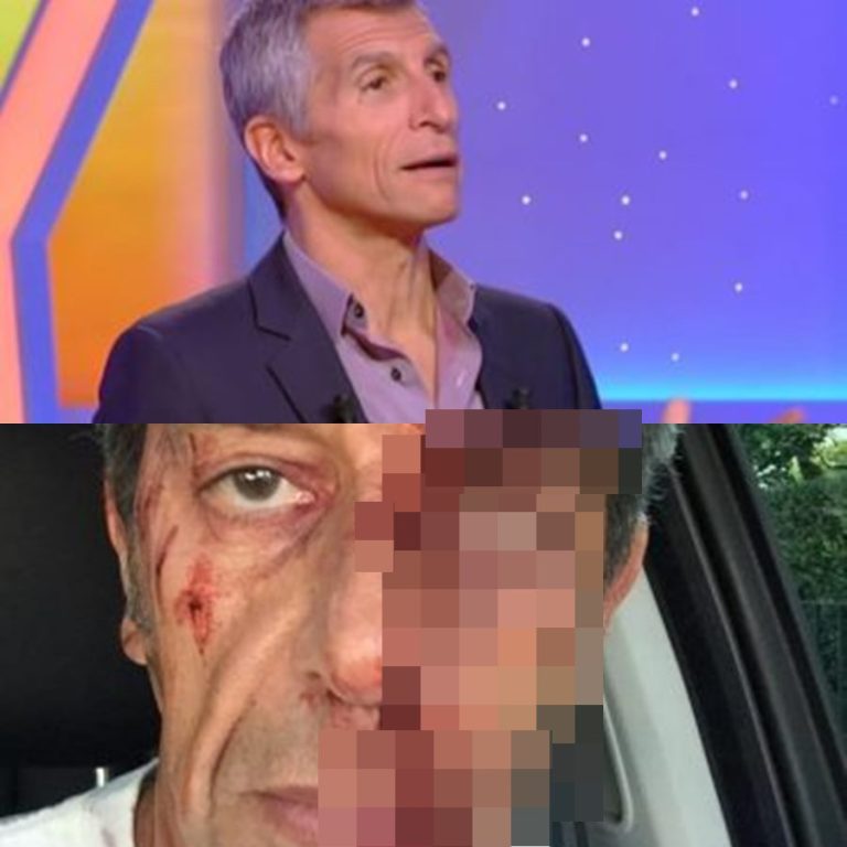 Quand Michel Cymes publie une photo de lui le visage tuméfié en accusant Nagui de l’avoir frappé pour une histoire de classement, Twitter s’enflamme. Canular génial ou rivalité inquiétante ? Derrière l’humour, une amitié réelle… mais les fans, eux, oscillent entre rires et doutes.